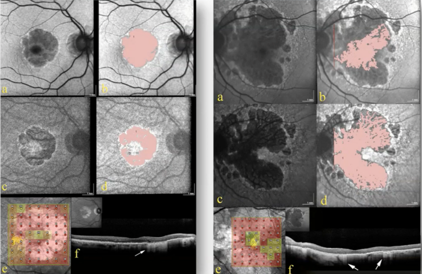 Imagerie Multimodale de l'Atrophie Géographique dans la DMLA