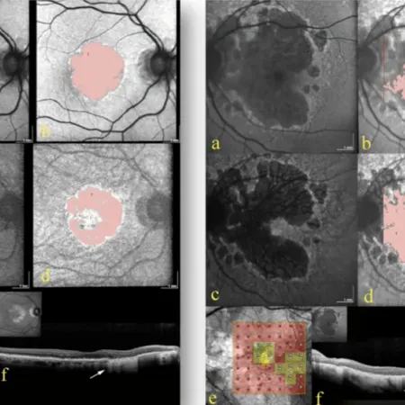 Imagerie Multimodale de l'Atrophie Géographique dans la DMLA